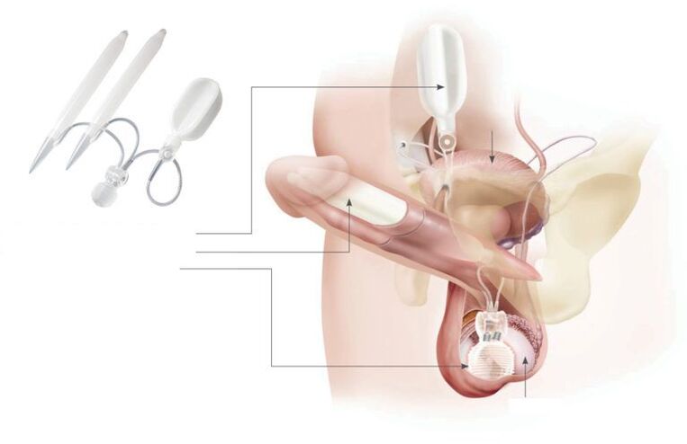 Gelimplantate im Penis