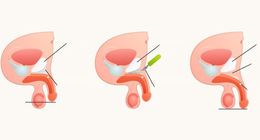 Ligamentotomie zur Vergrößerung des Penis